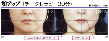 頬アップ（チークセラピー30 分）施術例　横山朝子さん（45歳）