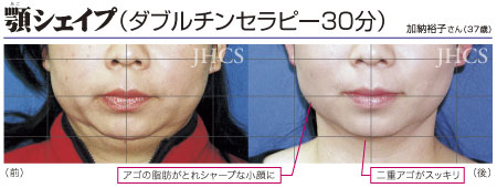 顎シェイプ（ダブルチンセラピー30 分）施術例　加納裕子さん（37歳）
